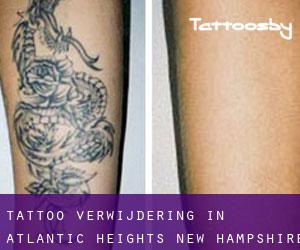 Tattoo verwijdering in Atlantic Heights (New Hampshire)