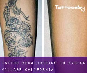 Tattoo verwijdering in Avalon Village (California)