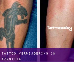 Tattoo verwijdering in Azkoitia