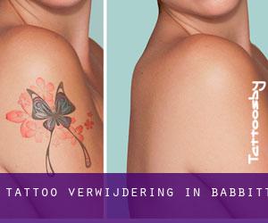 Tattoo verwijdering in Babbitt