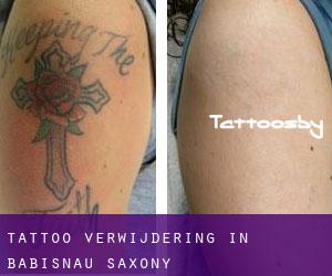 Tattoo verwijdering in Babisnau (Saxony)