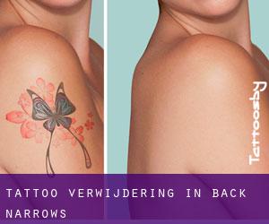 Tattoo verwijdering in Back Narrows