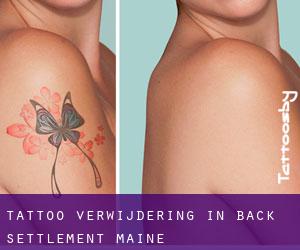 Tattoo verwijdering in Back Settlement (Maine)
