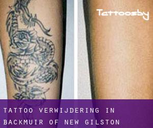 Tattoo verwijdering in Backmuir of New Gilston