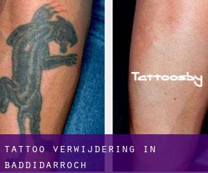 Tattoo verwijdering in Baddidarroch