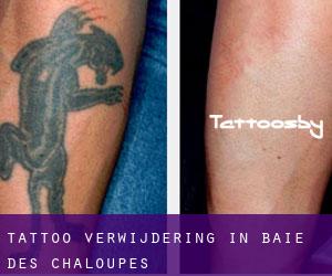 Tattoo verwijdering in Baie-des-Chaloupes