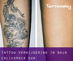 Tattoo verwijdering in Baja California Sur