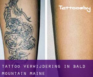 Tattoo verwijdering in Bald Mountain (Maine)