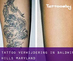 Tattoo verwijdering in Baldwin Hills (Maryland)
