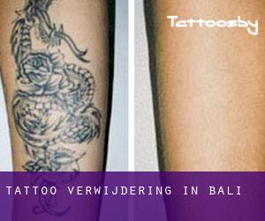 Tattoo verwijdering in Bali