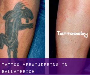 Tattoo verwijdering in Ballaterich