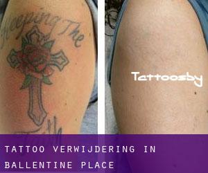 Tattoo verwijdering in Ballentine Place