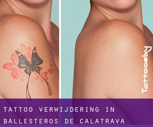 Tattoo verwijdering in Ballesteros de Calatrava