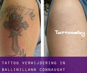 Tattoo verwijdering in Ballinillann (Connaught)