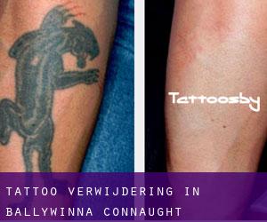 Tattoo verwijdering in Ballywinna (Connaught)