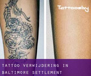 Tattoo verwijdering in Baltimore Settlement