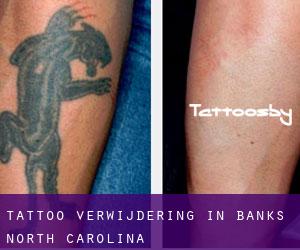 Tattoo verwijdering in Banks (North Carolina)