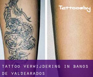 Tattoo verwijdering in Baños de Valdearados
