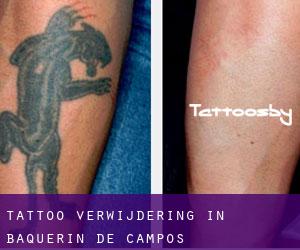 Tattoo verwijdering in Baquerín de Campos