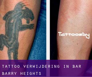 Tattoo verwijdering in Bar-Barry Heights