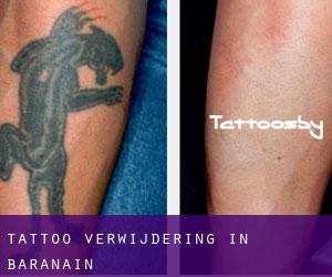 Tattoo verwijdering in Barañáin