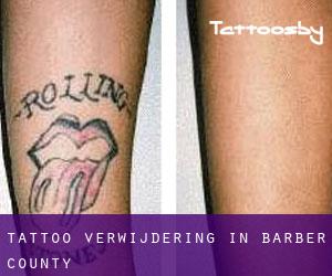 Tattoo verwijdering in Barber County