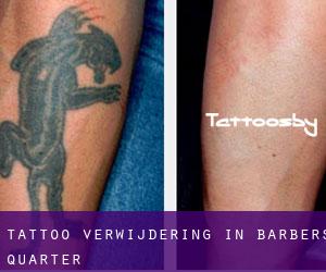 Tattoo verwijdering in Barbers Quarter