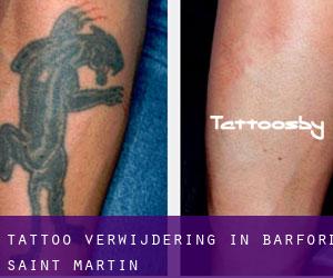 Tattoo verwijdering in Barford Saint Martin