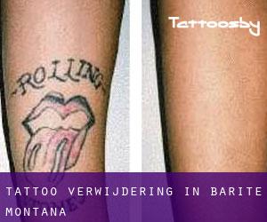 Tattoo verwijdering in Barite (Montana)
