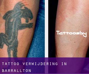 Tattoo verwijdering in Barrallton