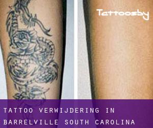 Tattoo verwijdering in Barrelville (South Carolina)