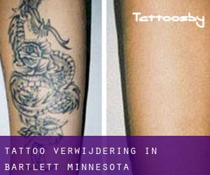 Tattoo verwijdering in Bartlett (Minnesota)
