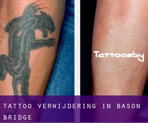 Tattoo verwijdering in Bason Bridge