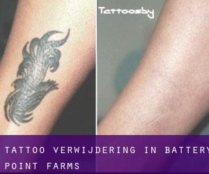 Tattoo verwijdering in Battery Point Farms