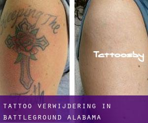 Tattoo verwijdering in Battleground (Alabama)