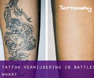 Tattoo verwijdering in Battles Wharf
