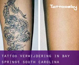 Tattoo verwijdering in Bay Springs (South Carolina)