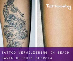 Tattoo verwijdering in Beach Haven Heights (Georgia)