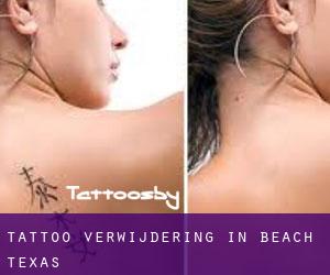 Tattoo verwijdering in Beach (Texas)