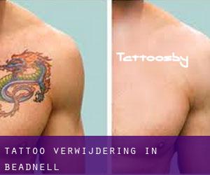 Tattoo verwijdering in Beadnell