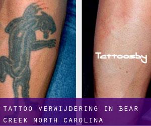 Tattoo verwijdering in Bear Creek (North Carolina)