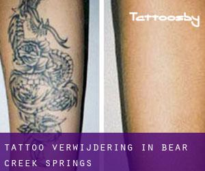 Tattoo verwijdering in Bear Creek Springs