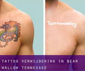 Tattoo verwijdering in Bear Wallow (Tennessee)