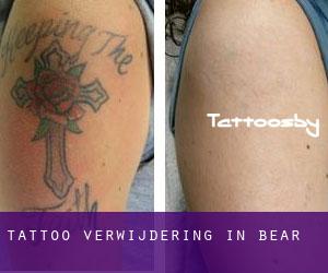 Tattoo verwijdering in Bear