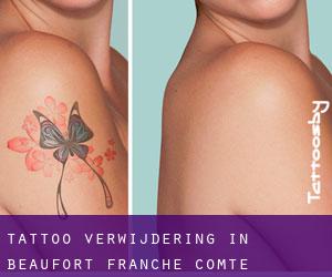 Tattoo verwijdering in Beaufort (Franche-Comté)