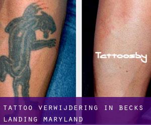 Tattoo verwijdering in Becks Landing (Maryland)