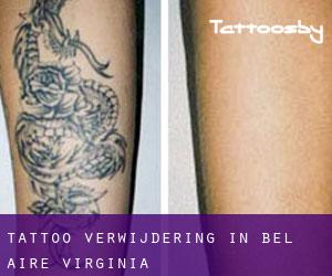 Tattoo verwijdering in Bel-Aire (Virginia)