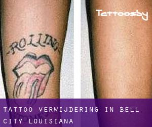 Tattoo verwijdering in Bell City (Louisiana)