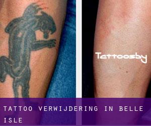 Tattoo verwijdering in Belle Isle