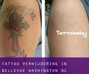 Tattoo verwijdering in Bellevue (Washington, D.C.)
